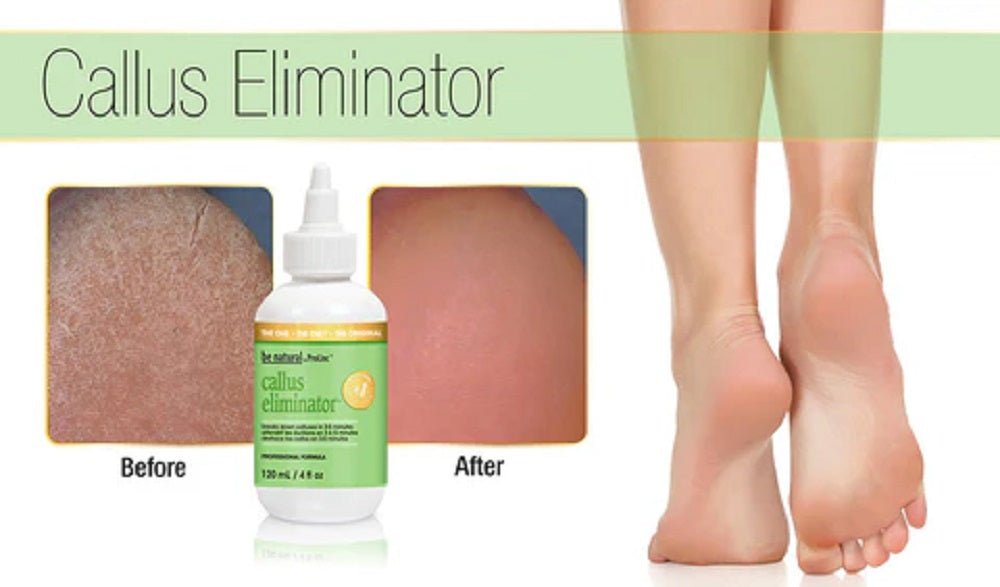 BE NATURAL CALLUS ELIMINATOR PRE - SOAKED PADS 200 CT - Purple Beauty Supplies