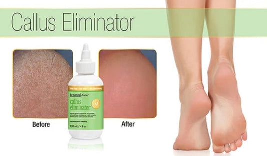 BE NATURAL CALLUS ELIMINATOR PRE - SOAKED PADS 200 CT - Purple Beauty Supplies