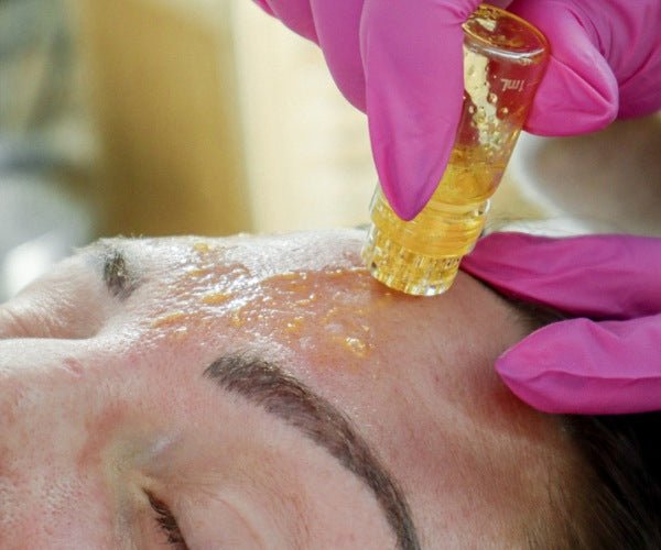 HYDRA NEEDLE 20 PIN | 1 MM - Purple Beauty Supplies